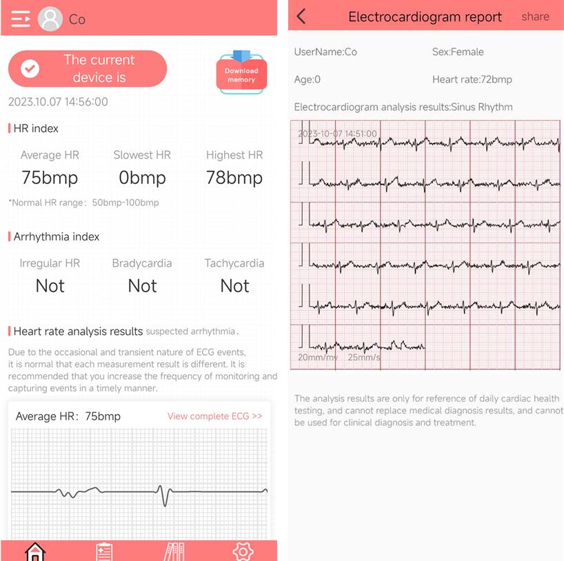 ECG
