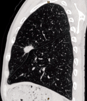 Sagittal Plane — Pulmonary Nodule in the Left Upper Lobe Płaszczyzna strzałkowa — guzek płucny w lewym górnym płacie
