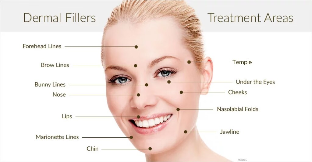 Dermal Filler Treatment Areas 真皮填充剂改善区域