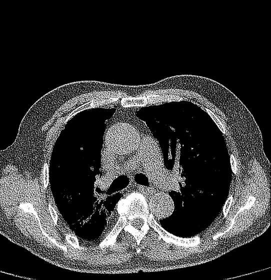 CT Scan Image of Ultra-Low Dose Lung Screening (1) Obraz tomografii komputerowej przedstawiający badanie przesiewowe płuc przy użyciu ultraniskich dawek (1)