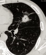 Axial Plane — Pulmonary Nodule in the Left Upper Lobe Płaszczyzna osiowa — guzek płucny w lewym górnym płacie