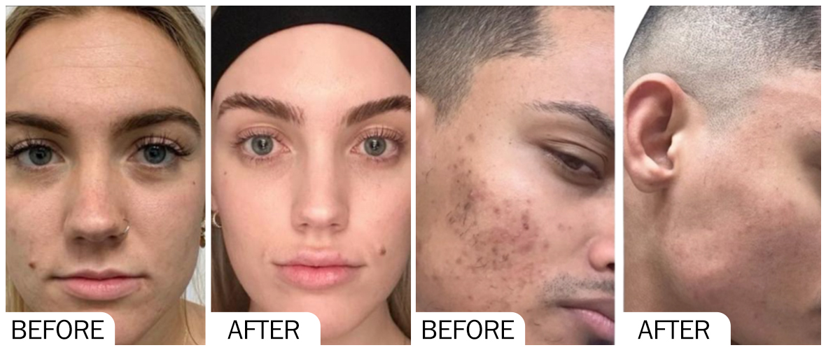 图片 3 嫩肤前后对比 AOMA