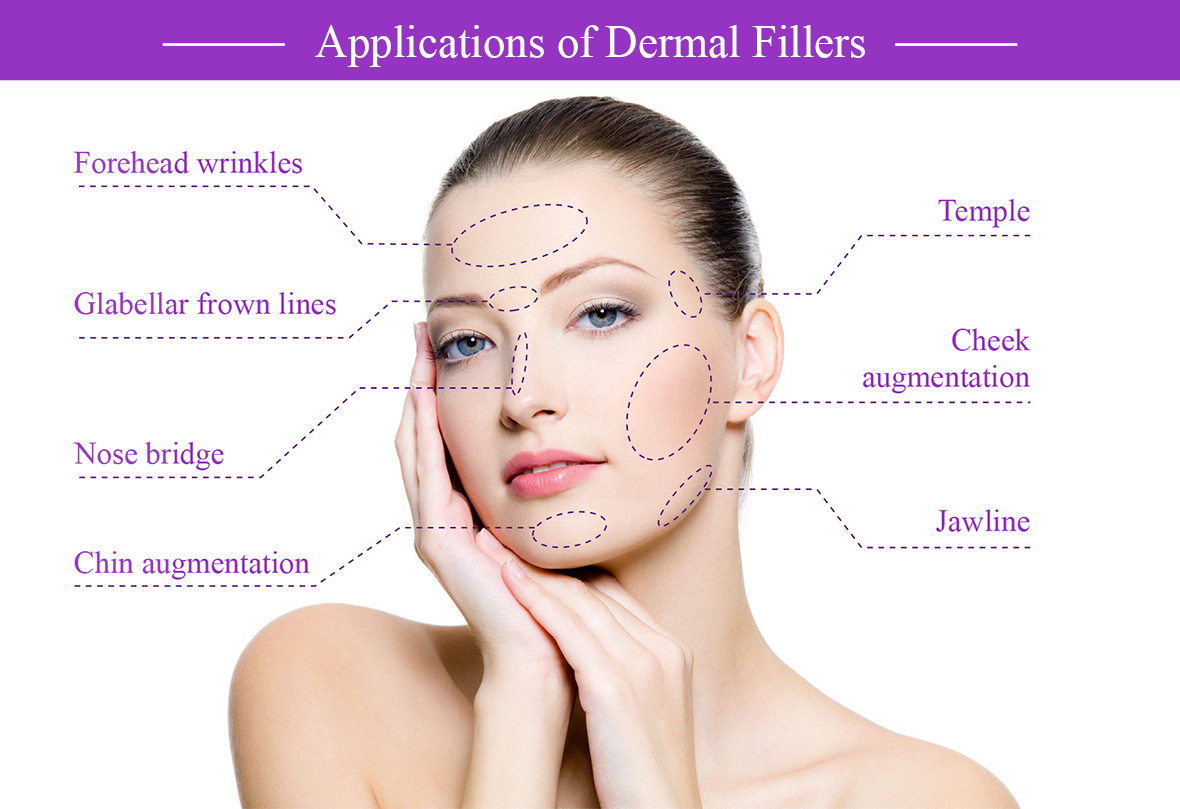 Dermal Filler Areas 真皮填充區域