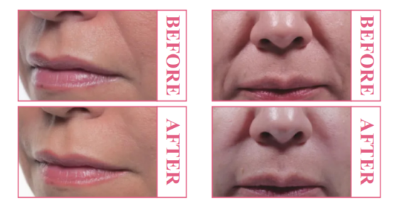 Before & after pictures PLLA PLLA 前后对比图