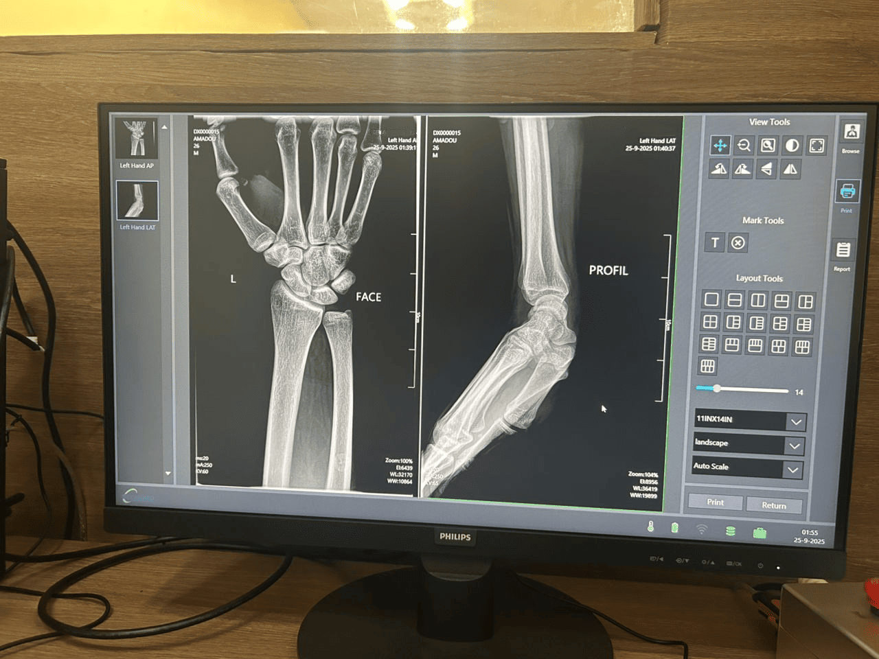 Bardzo wyraźny skan diagnostyczny wykonany przez Michaela w Nigrze, wykazujący doskonałą rozdzielczość obrazu i kalibrację oprogramowania systemu rentgenowskiego MX-DR500A10.