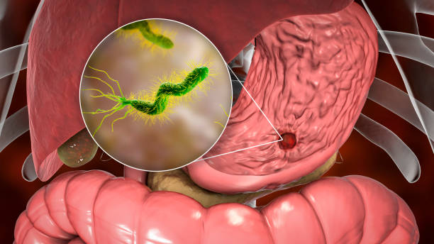 Helicobacter pylori