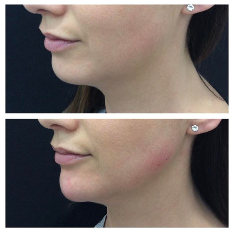 Foardat & nei byld fan Aoma Chin Filler