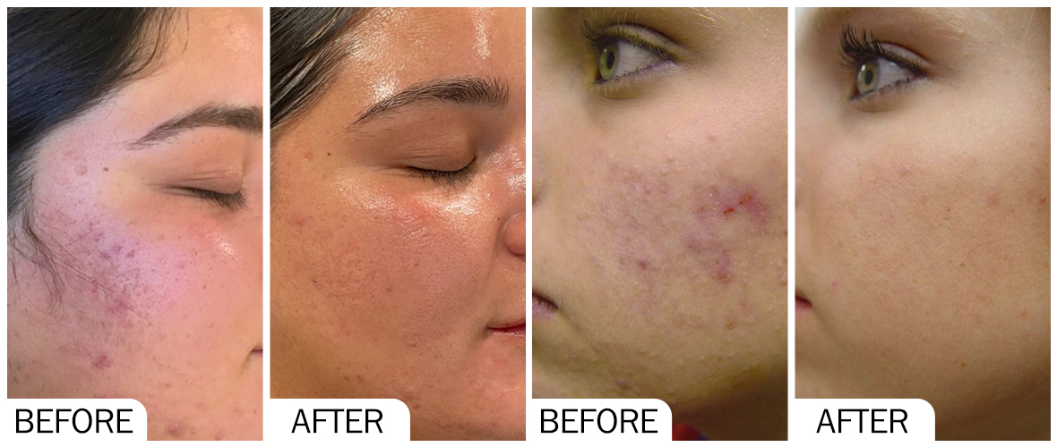 AOMA 嫩膚前後對比