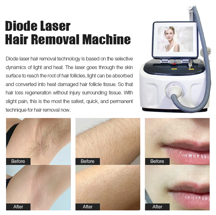 Machine d'&eacute;pilation au laser &agrave; diode