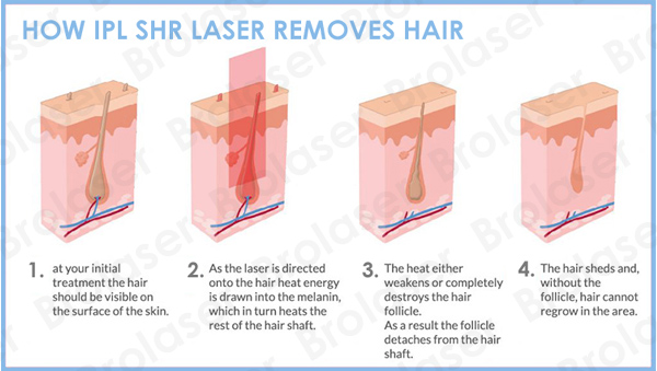 IPL SHR hair removal Épilation IPL SHR