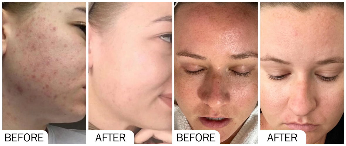 AOMA 皮肤提亮肤色前后