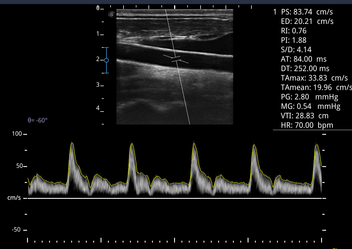 SonoScape E1 Portable B/W Ultrasound Imago