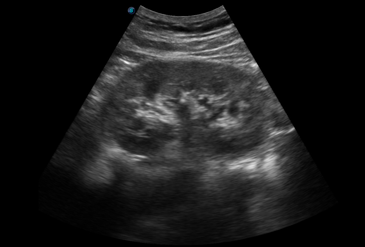 SonoScape E1 Portable B/W Ultrasound Imago