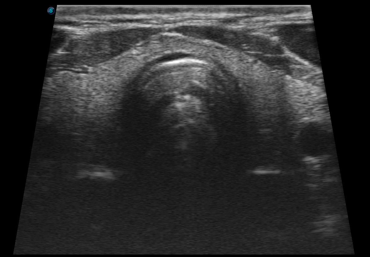 SonoScape E1 Portable B/W Ultrasound Imago