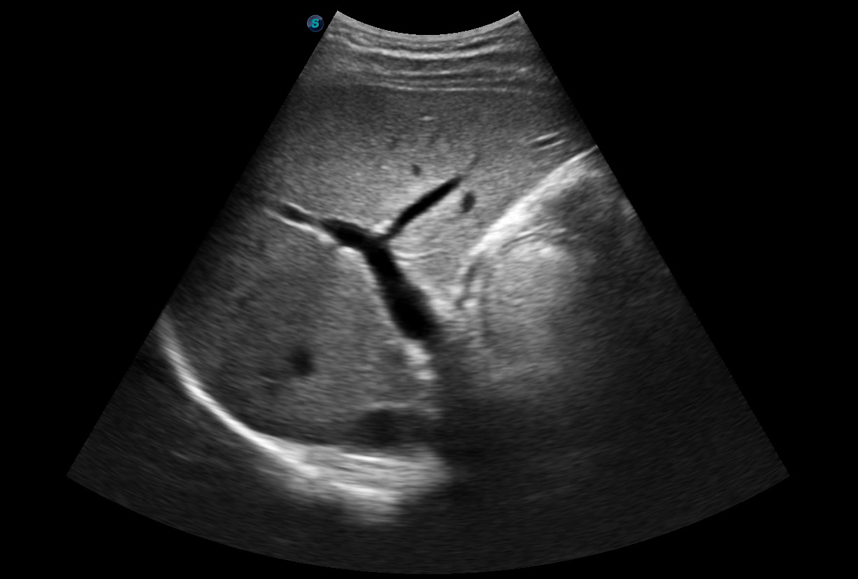 SonoScape E1 Portable B/W Ultrasound Imago